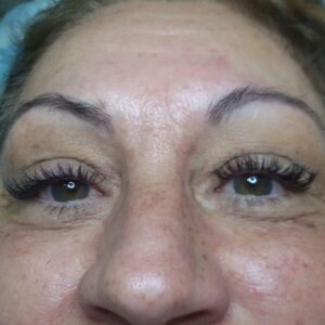 fv-laser-fibroblast-antes-despues03